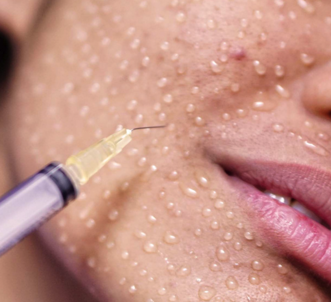 Mezoterapie a biorevitalizace