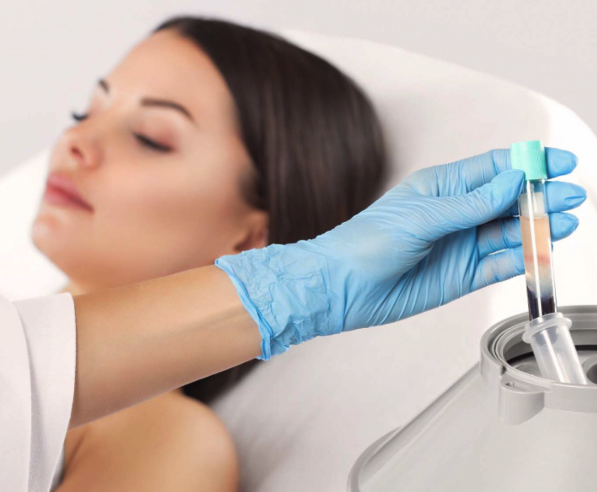 PRP – plazmoterapie